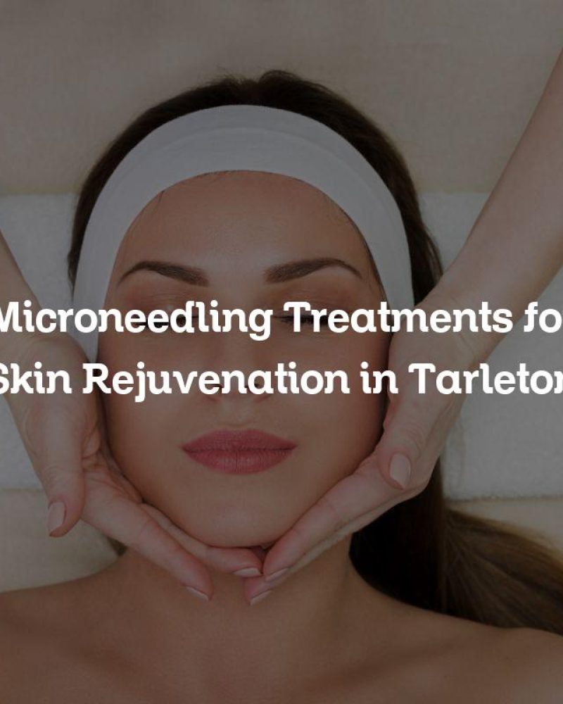Microneedling Treatments for Skin Rejuvenation in Tarleton