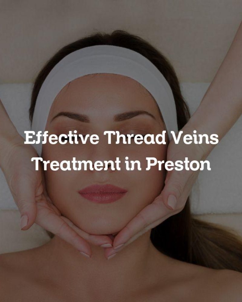 Effective Thread Veins Treatment in Preston
