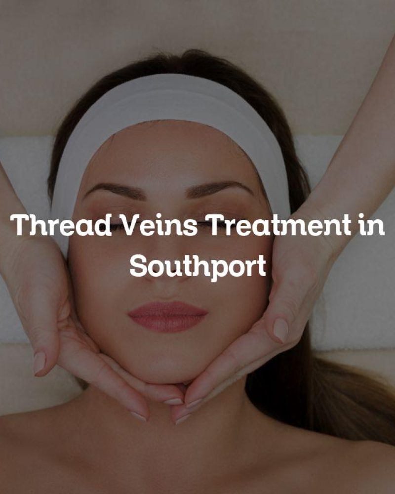 Thread Veins Treatment in Southport